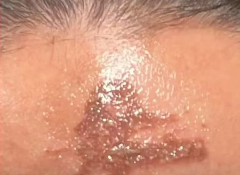  Em Sobral: Pessoas ficam com a testa marcada após se queimarem com cinzas na igreja.